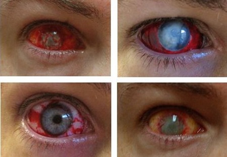 Read more about the article Eye Trauma Contact Lenses